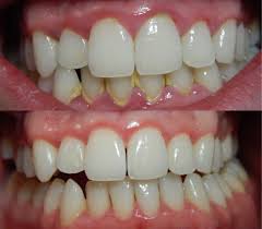 gum disease image cc search