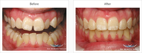 adult braces in leicestershire