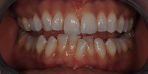 6 month smile