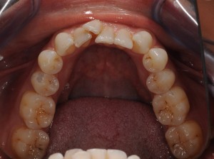 cosmetic braces before and after