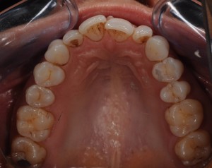Braces before and after