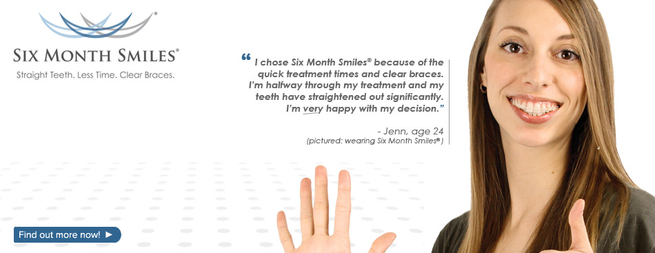 Six Month Smiles Braces