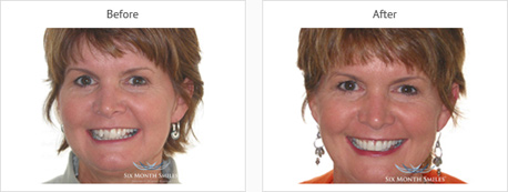 six month smile brace before picture