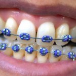 braces on teeth leicestershire