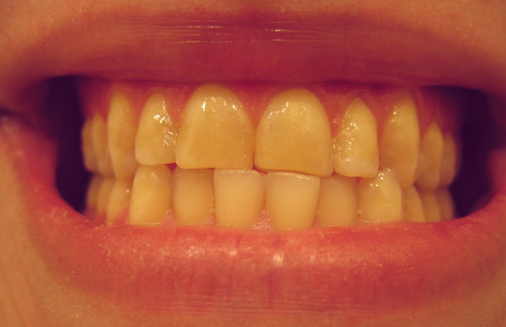 do you clench your teeth?