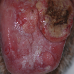 mouth cancer