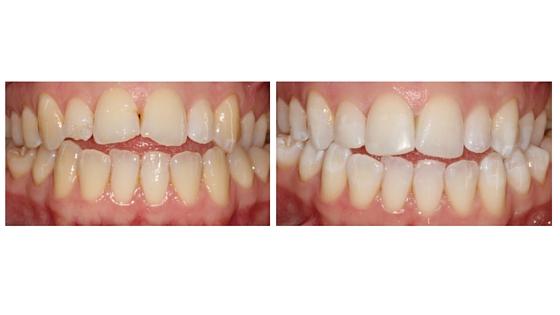 Teeth whitening and composite build ups