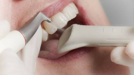AirFlow tooth cleaning